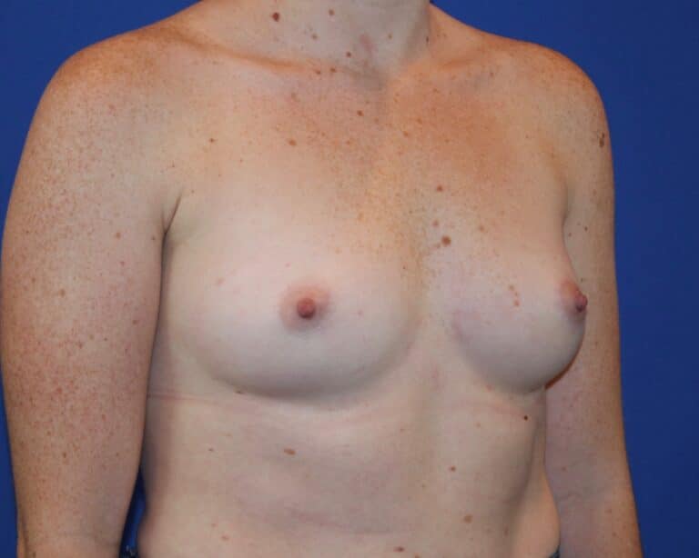 Before Image: Patient Case #2907 - right-front-oblique