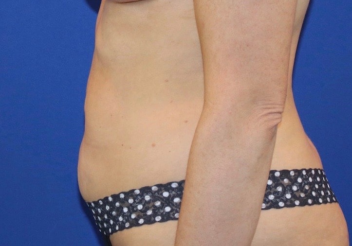 Before Image: Patient Case #3871 - left-side