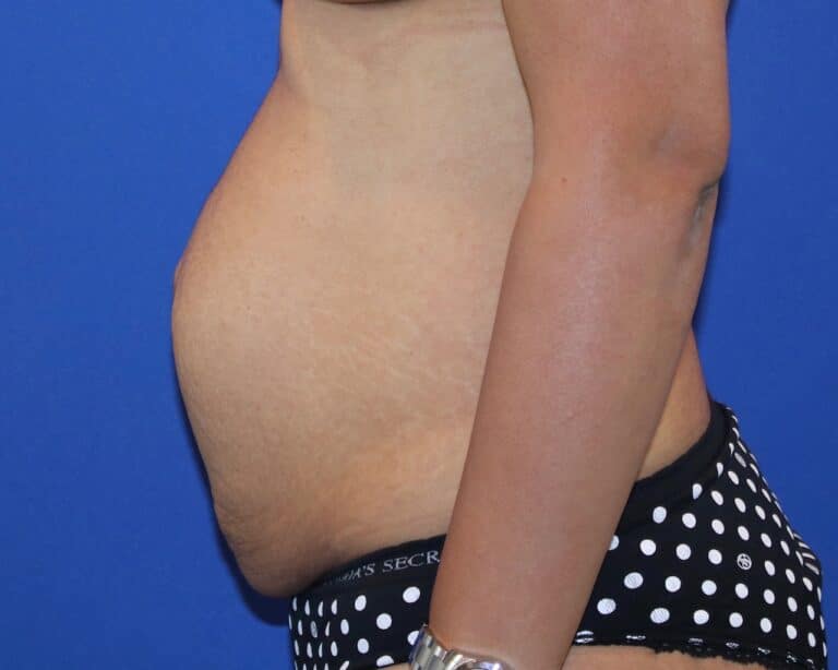 Before Image: Patient Case #3867 - left-side