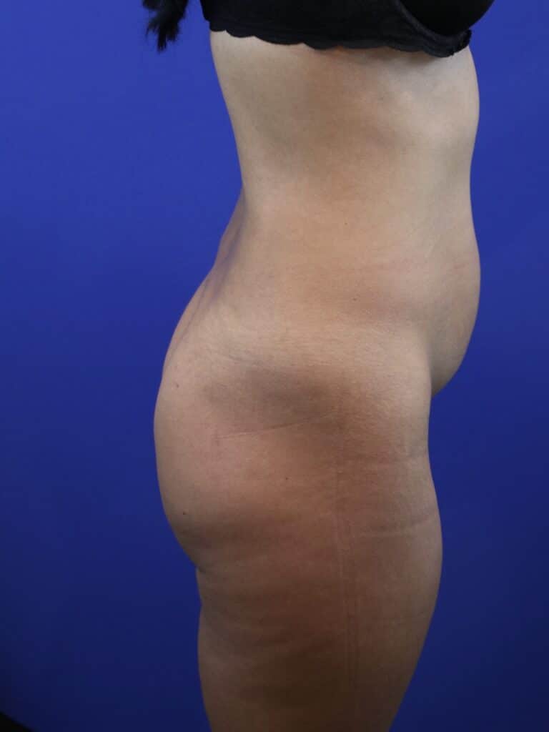 Before Image: Patient Case #4012 - right-side