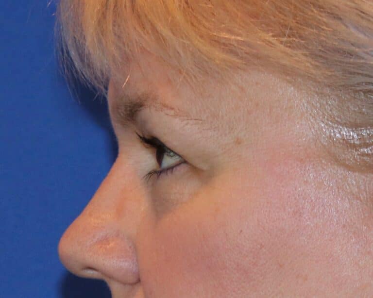 Before Image: Patient Case #3068 - left-side