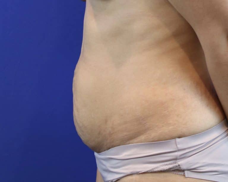 Before Image: Patient Case #3109 - left-side