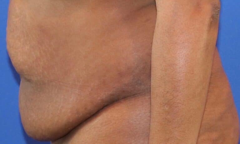 Before Image: Patient Case #3118 - left-side