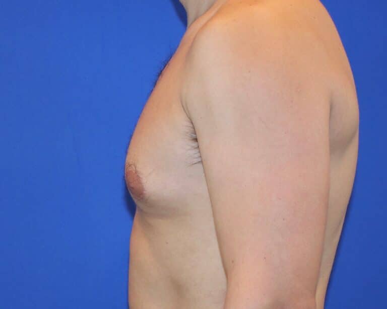 Before Image: Patient Case #1053 - left-side