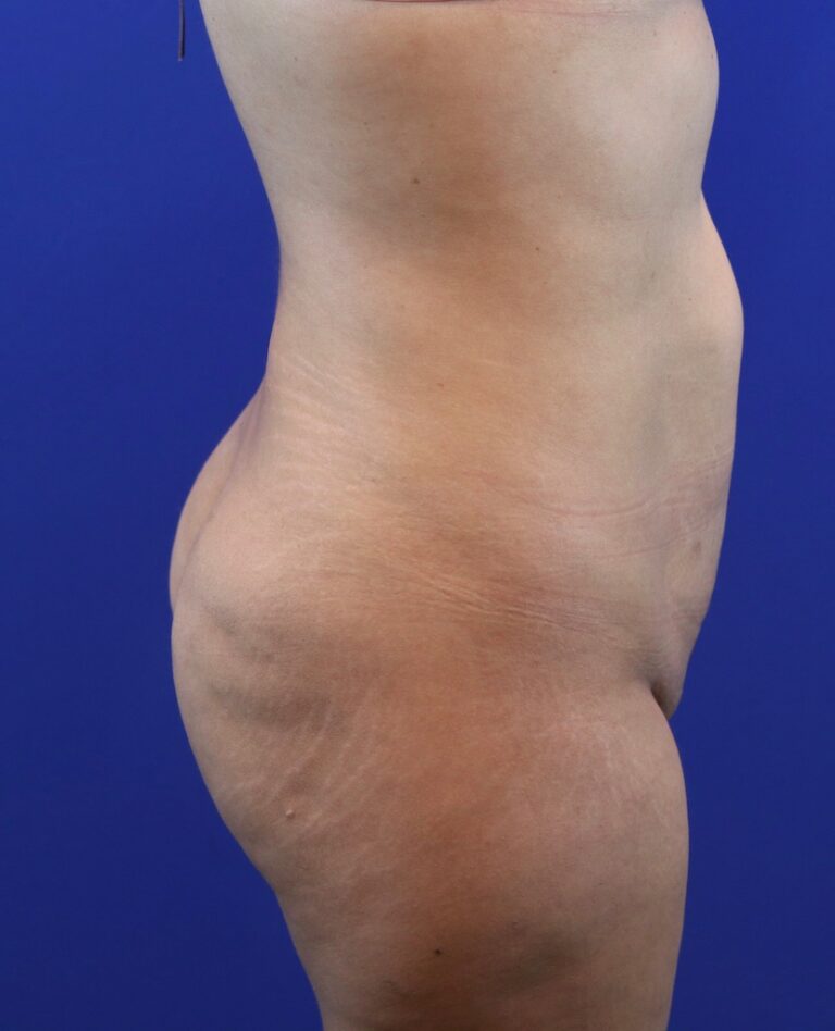 Before Image: Patient Case #4002 - right-side