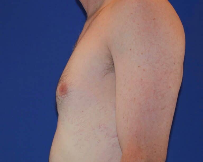 Before Image: Patient Case #1049 - left-side