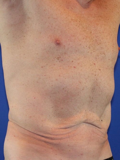 Before Image: Patient Case #3990 - right-front-oblique