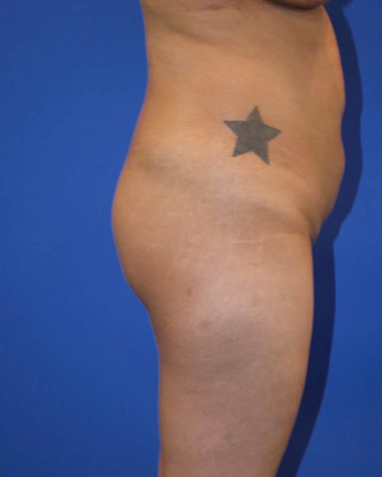 Before Image: Patient Case #4009 - right-side