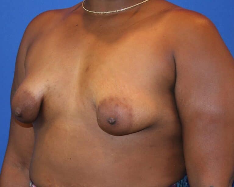 Before Image: Patient Case #3920 - left-front-oblique