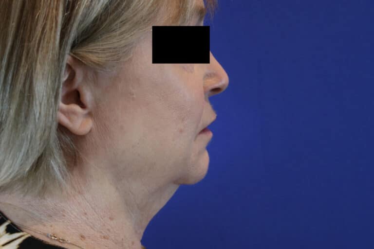 Before Image: Patient Case #3621 - right-side