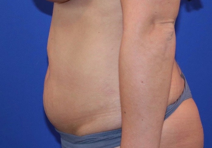Before Image: Patient Case #3890 - left-side