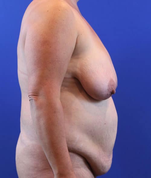 Before Image: Patient Case #3006 - right-side