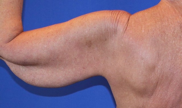 Before Image: Patient Case #1107 - back