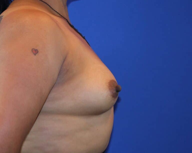 Before Image: Patient Case #5749 - right-side