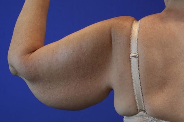 Before Image: Patient Case #1123 - back