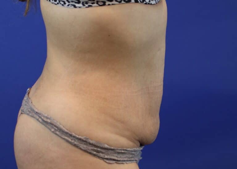Before Image: Patient Case #3883 - right-side