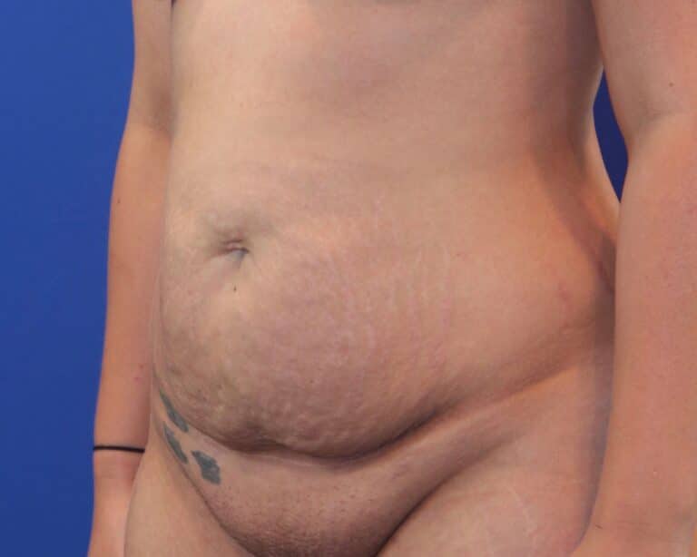 Before Image: Patient Case #3884 - left-front-oblique