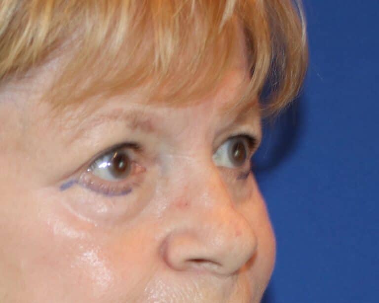 Before Image: Patient Case #3310 - right-front-oblique