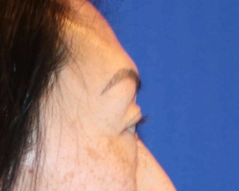 Before Image: Patient Case #3332 - right-side