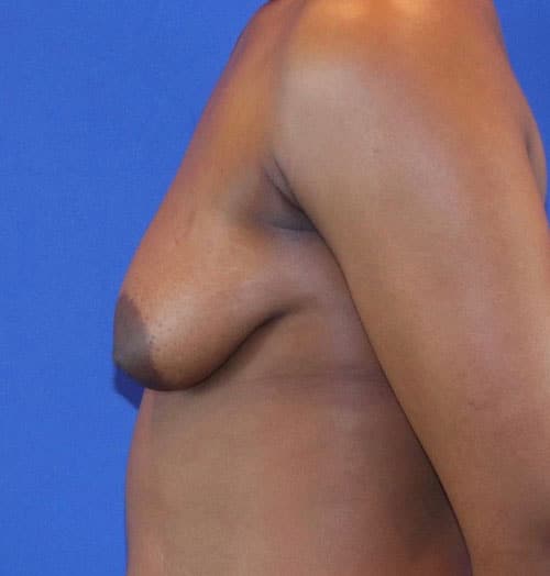 Before Image: Patient Case #3017 - left-side
