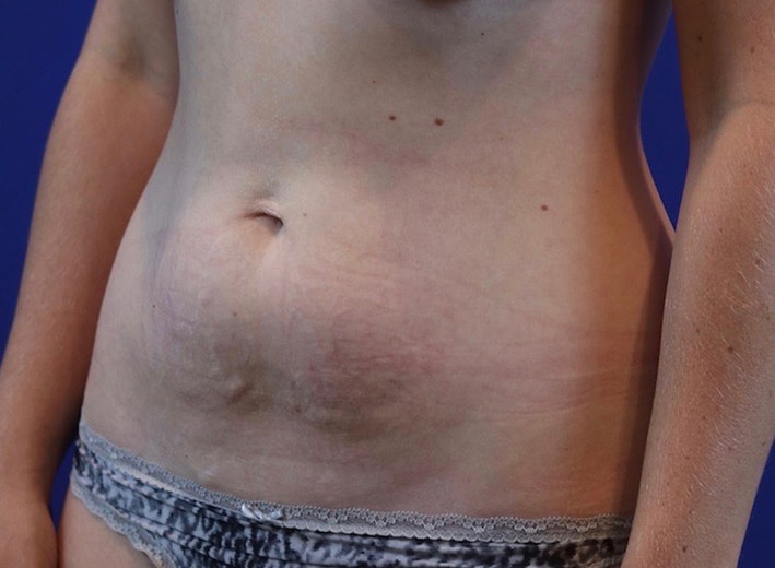 Before Image: Patient Case #3988 - left-front-oblique
