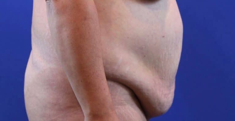 Before Image: Patient Case #3869 - right-side