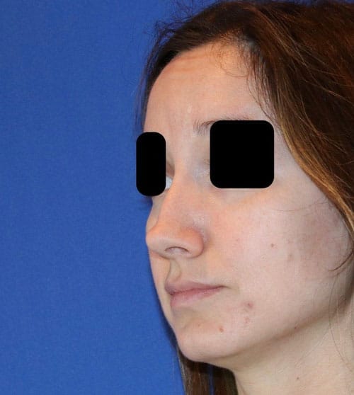 Before Image: Case Patient 2 - left-front-oblique