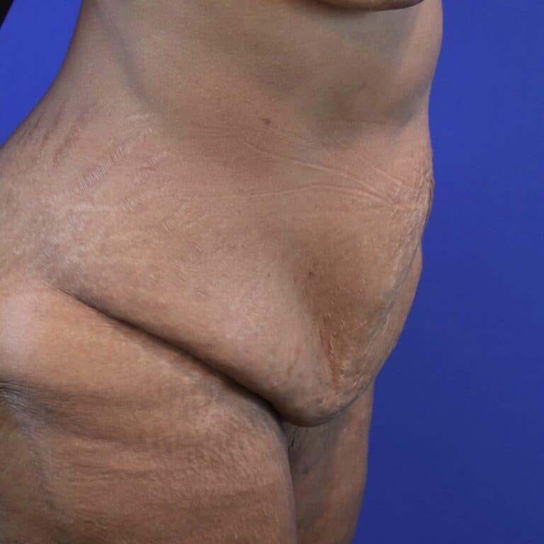 Before Image: Patient Case #3119 - right-side