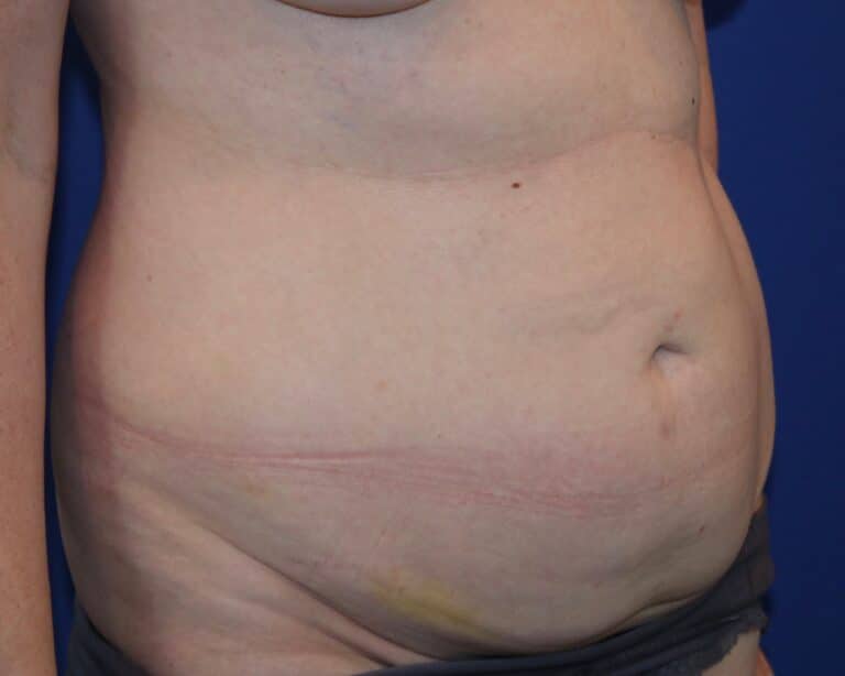 Before Image: Patient Case #3882 - right-front-oblique