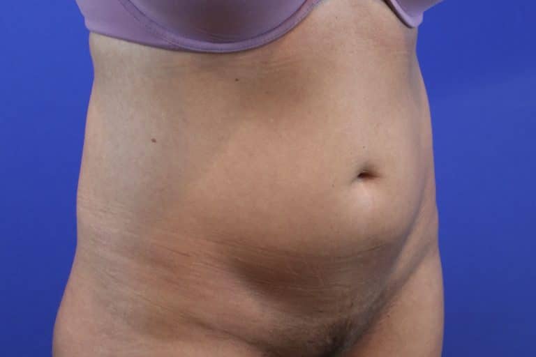 Before Image: Patient Case #3215 - right-front-oblique