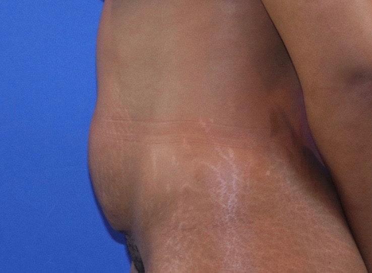 Before Image: Patient Case #3775 - left-side