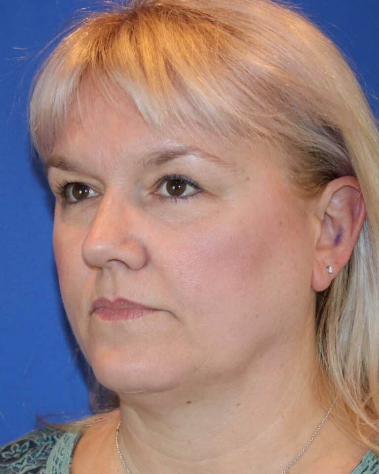 Before Image: Patient Case #3614 - left-front-oblique
