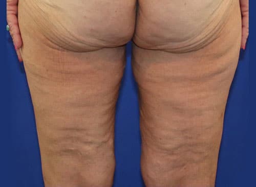 Before Image: Patient 1 - back