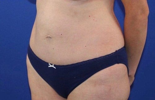 After Image: Patient Case #3989 - left-front-oblique