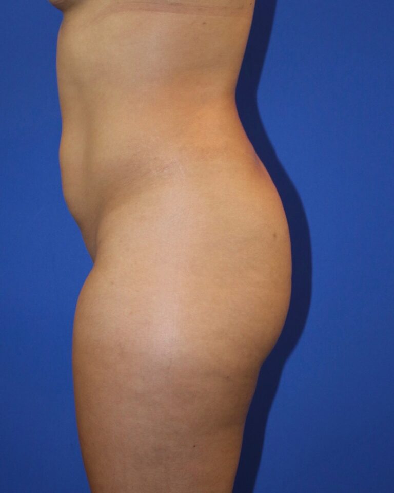 Before Image: Patient Case #4001 - left-side