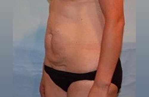 Before Image: Patient Case #3989 - left-front-oblique