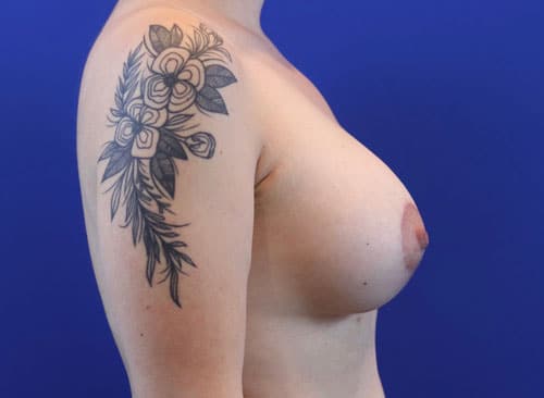 After Image: Patient Case #3009 - right-side