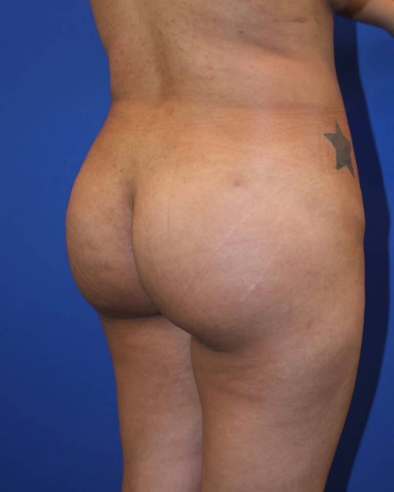 After Image: Patient Case #4009 - right-back-oblique
