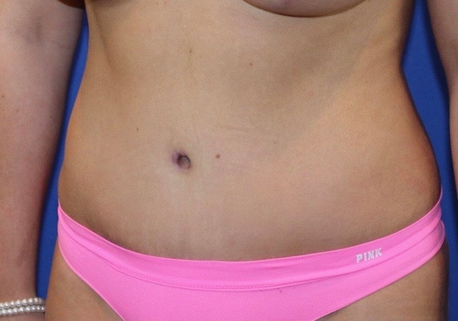 After Image: Patient Case #3890 - left-front-oblique