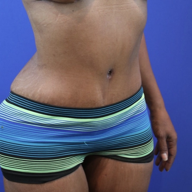 After Image: Patient Case #3119 - right-front-oblique