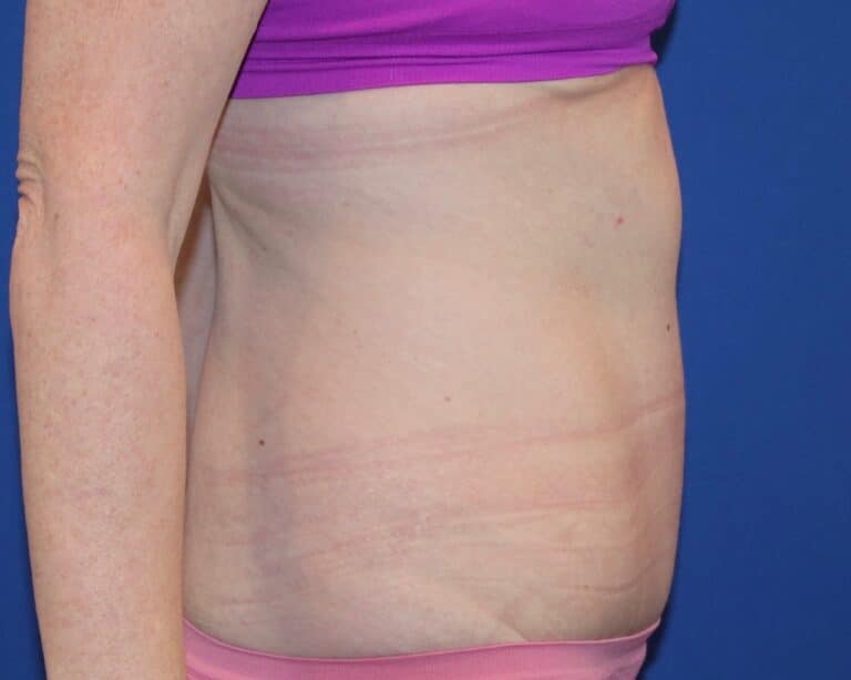 After Image: Patient Case #3882 - right-side
