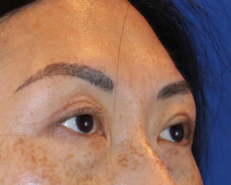 After Image: Patient Case #3332 - right-front-oblique