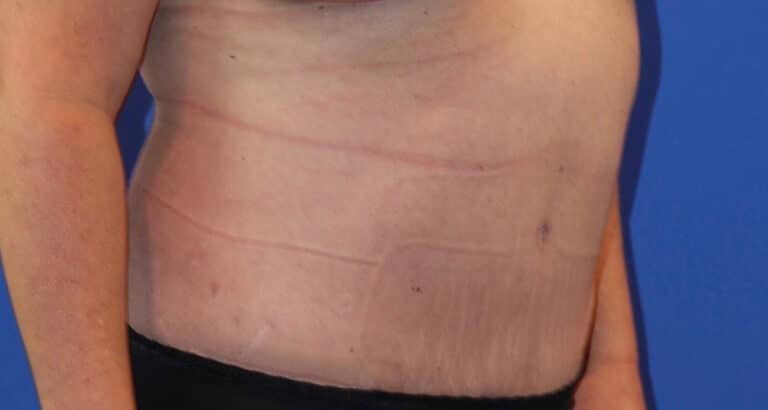 After Image: Patient Case #3869 - right-front-oblique