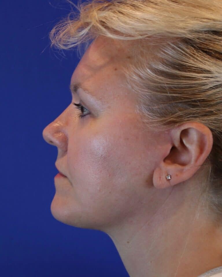 After Image: Patient Case #3614 - left-side