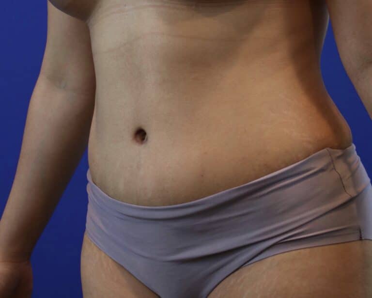 After Image: Patient Case #3109 - left-front-oblique