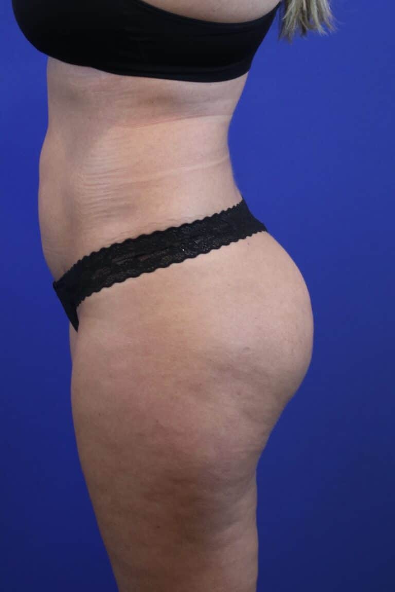 After Image: Patient Case #4010 - left-side