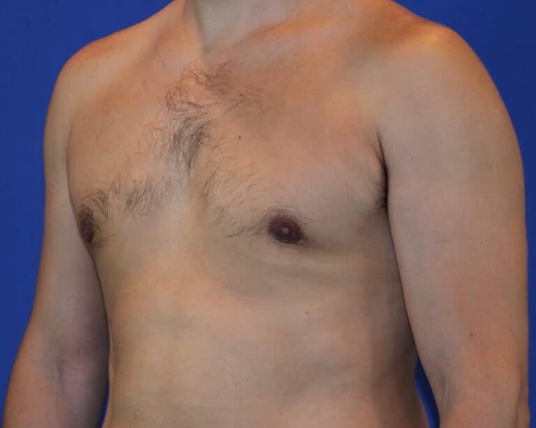 After Image: Patient Case #1053 - left-front-oblique