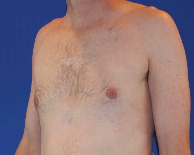 After Image: Patient Case #1049 - left-front-oblique
