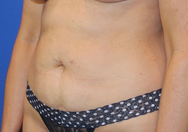 Before Image: Patient Case #3871 - left-front-oblique