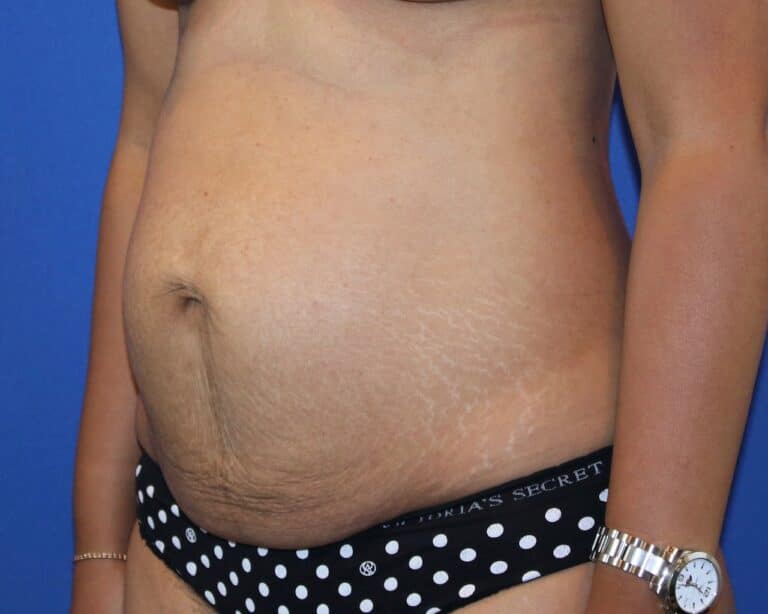 Before Image: Patient Case #3867 - left-front-oblique